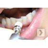 Полировка зуба профилактической пастой