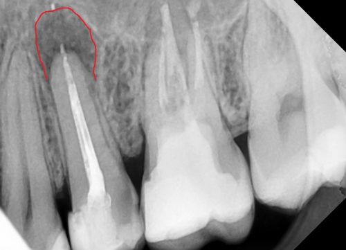 ранее леченый зуб по поводу пульпита